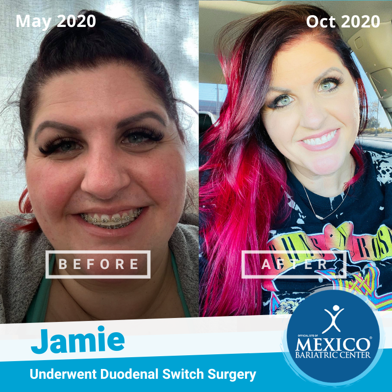 Jamie G before & after Duodenal Switch 2020