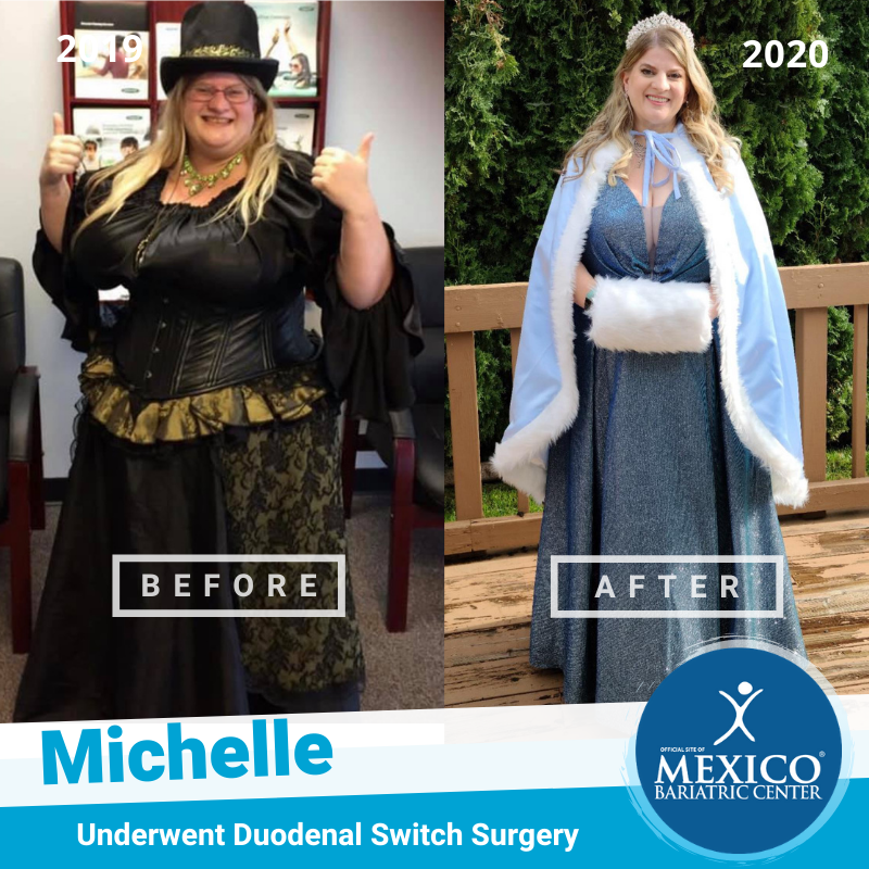 Michelle Duodenal Switch Success Before After - Mexico Bariatric Center