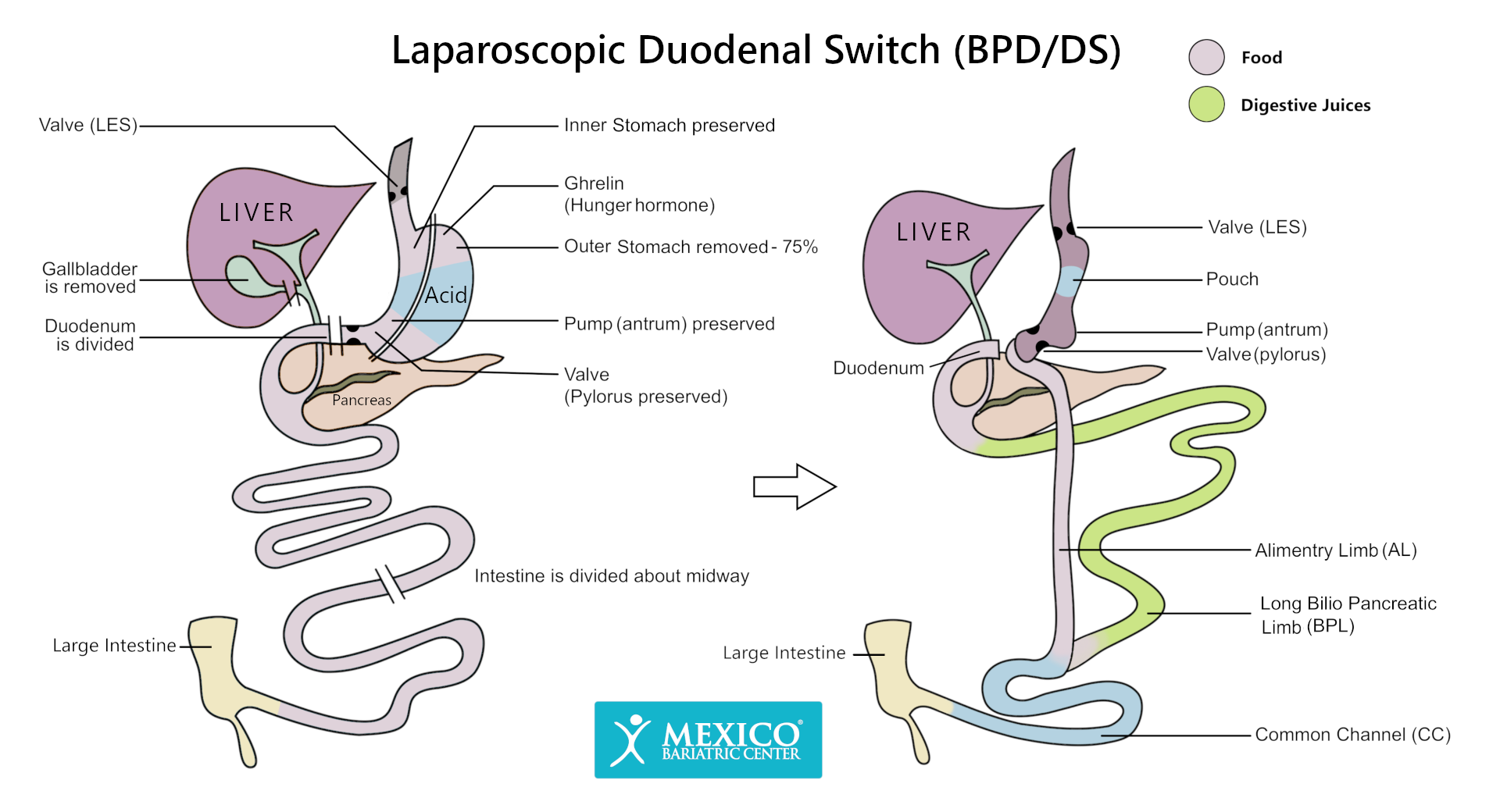 Laparoscopic Duodenal Switch (BPD-DS)