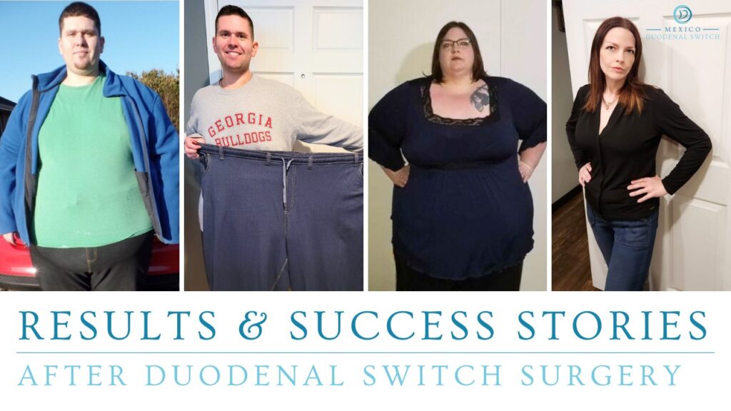 Results and Weight Loss Success Stories__Mexico Duodenal Switch